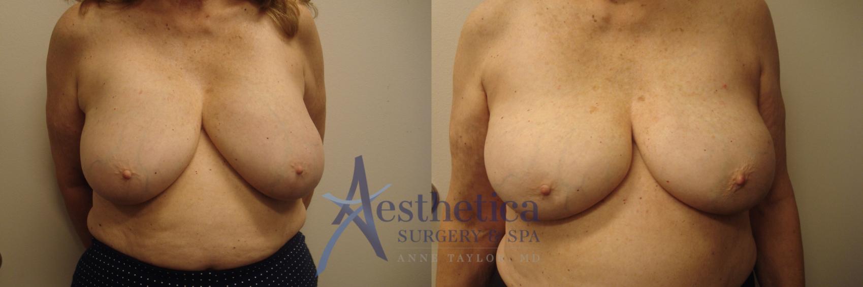 Breast Implant Removal  Case 542 Before & After Front | Worthington, OH | Aesthetica Surgery & Spa
