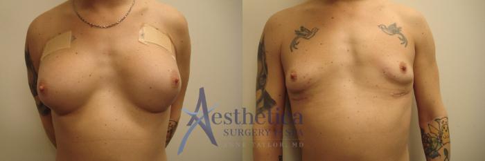 Breast Implant Removal  Case 587 Before & After Front | Worthington, OH | Aesthetica Surgery & Spa