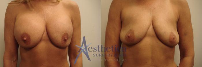 Breast Implant Removal  Case 608 Before & After Front | Columbus, OH | Aesthetica Surgery & Spa