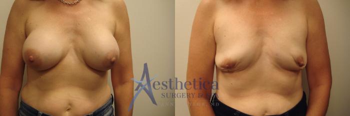 Breast Implant Removal  Case 629 Before & After Front | Worthington, OH | Aesthetica Surgery & Spa