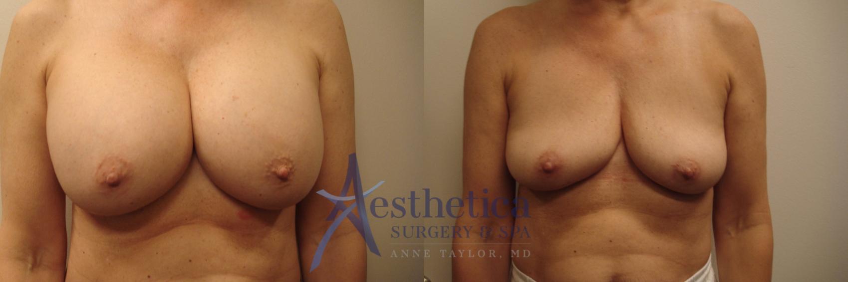 Breast Implant Removal  Case 639 Before & After Front | Columbus, OH | Aesthetica Surgery & Spa