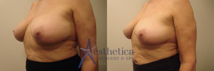 Breast Implant Removal  Case 665 Before & After Right Oblique | Columbus, OH | Aesthetica Surgery & Spa