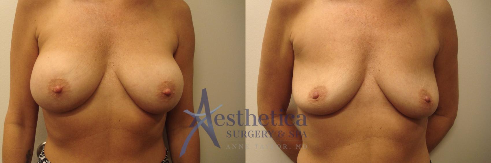 Breast Implant Removal  Case 666 Before & After Front | Columbus, OH | Aesthetica Surgery & Spa