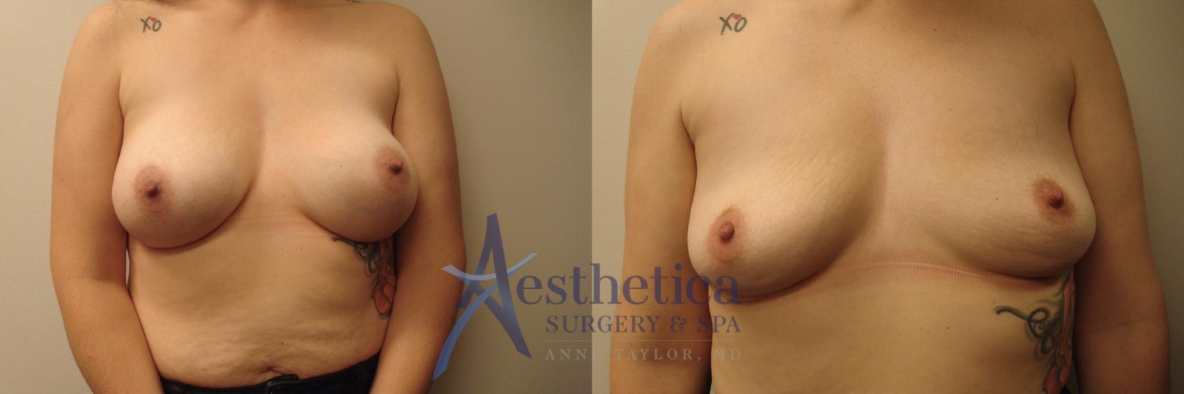 Breast Implant Removal  Case 667 Before & After Front | Columbus, OH | Aesthetica Surgery & Spa