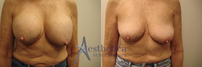 Breast Implant Removal  Case 691 Before & After Front | Columbus, OH | Aesthetica Surgery & Spa