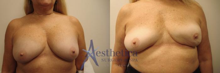 Breast Implant Removal  Case 692 Before & After Front | Columbus, OH | Aesthetica Surgery & Spa