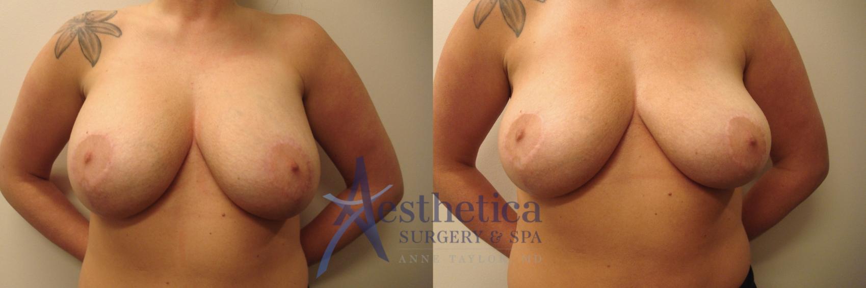 Breast Implant Removal  Case 695 Before & After Front | Columbus, OH | Aesthetica Surgery & Spa