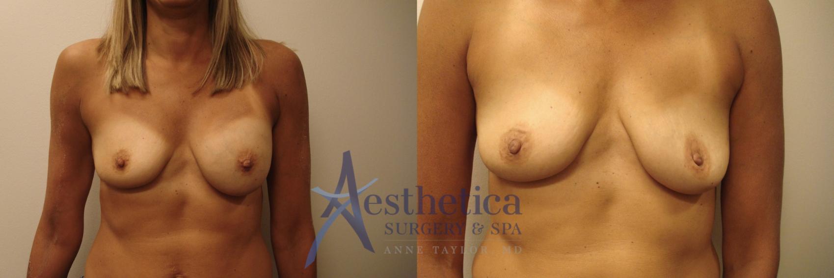 Breast Implant Removal  Case 717 Before & After Front | Columbus, OH | Aesthetica Surgery & Spa