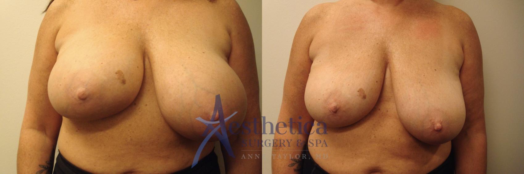 Breast Implant Removal  Case 750 Before & After Front | Columbus, OH | Aesthetica Surgery & Spa