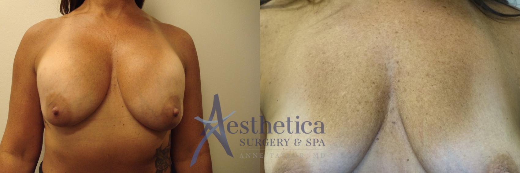 Breast Implant Removal  Case 771 Before & After Front | Columbus, OH | Aesthetica Surgery & Spa