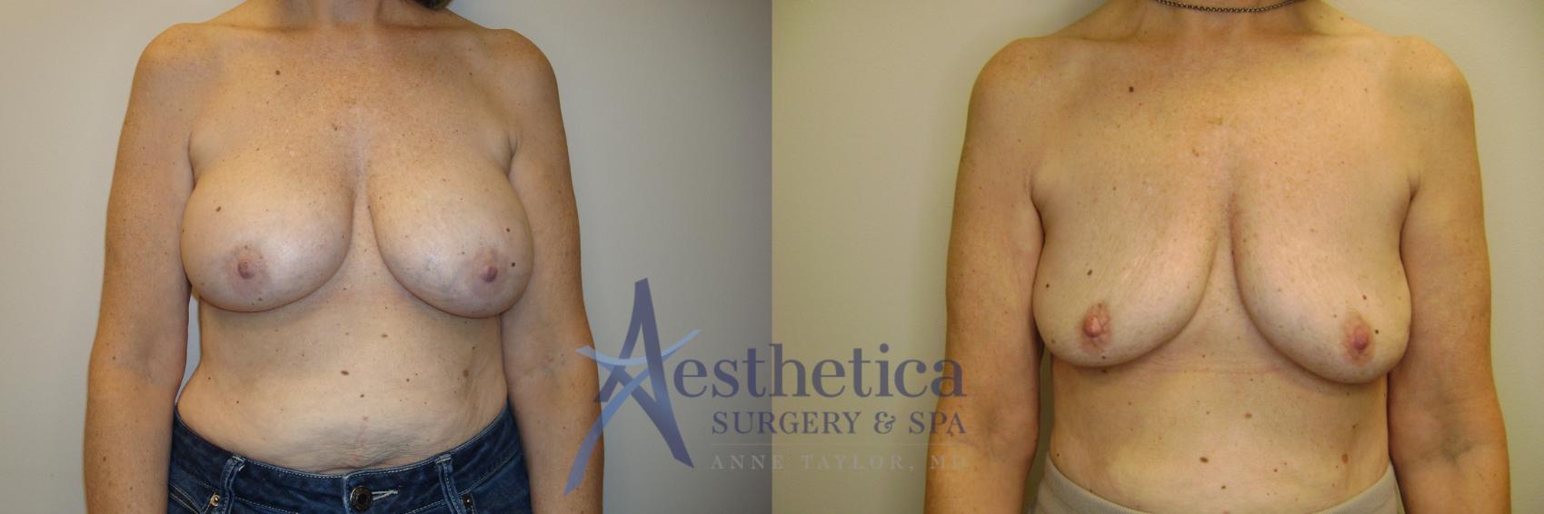 Breast Implant Removal  Case 774 Before & After Front | Columbus, OH | Aesthetica Surgery & Spa