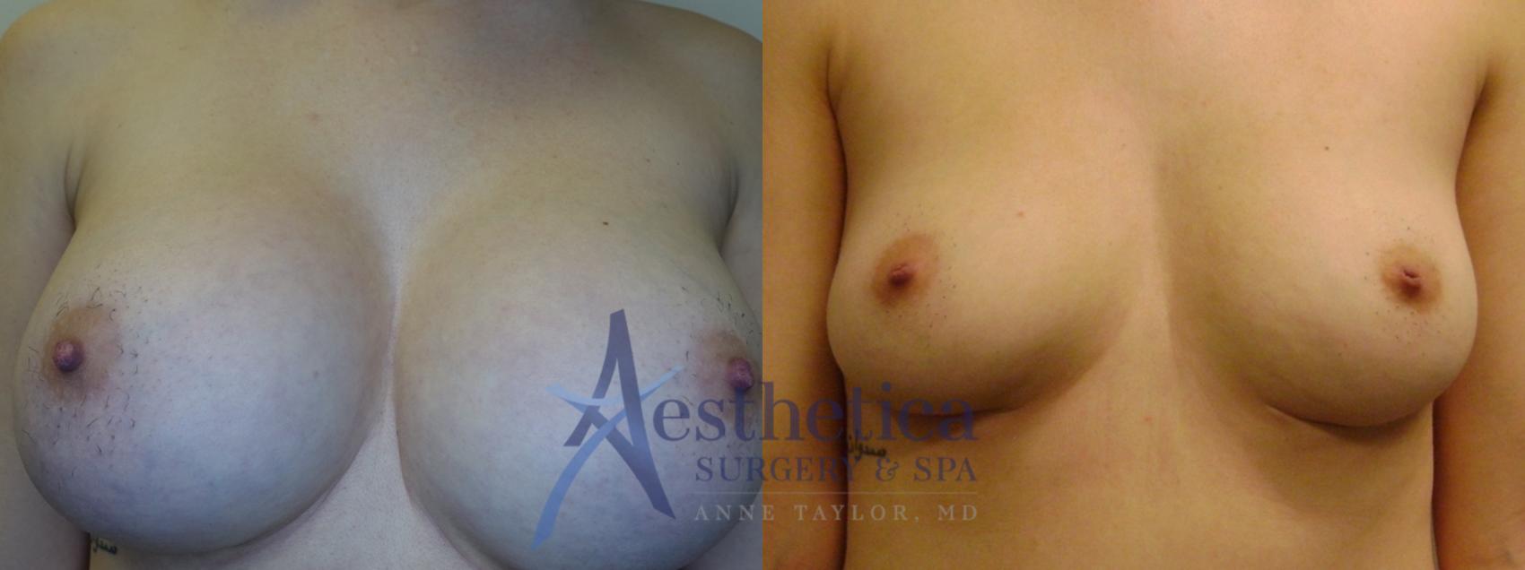 Breast Implant Removal  Case 777 Before & After Front | Columbus, OH | Aesthetica Surgery & Spa