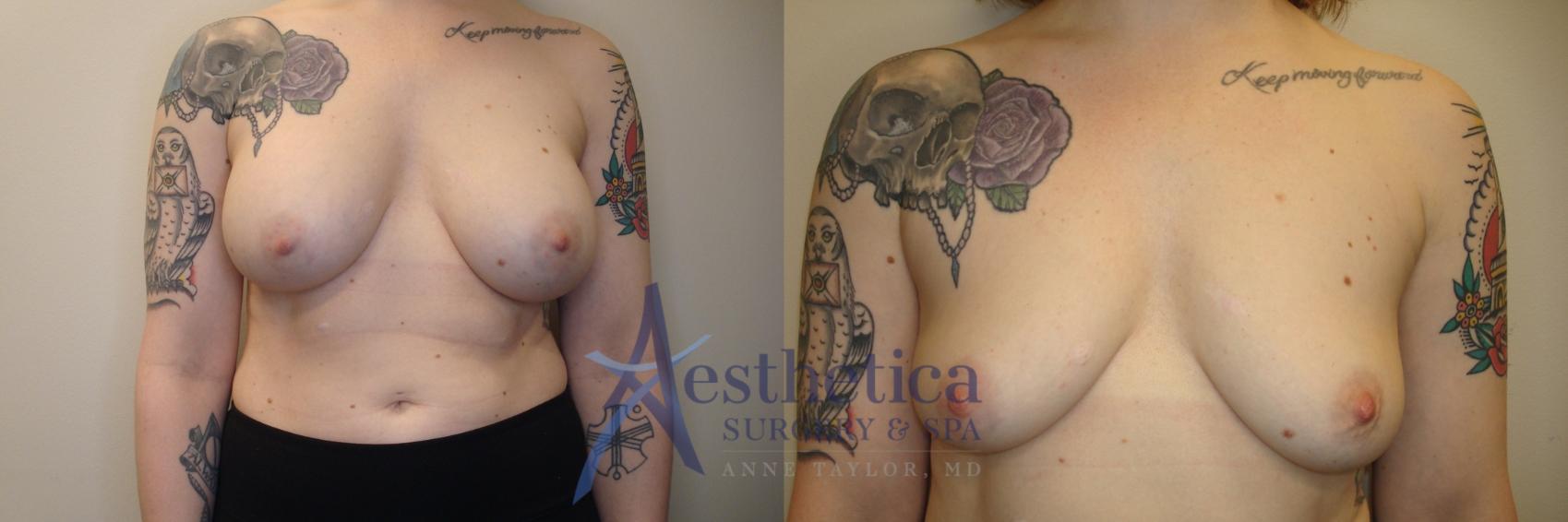 Breast Implant Removal  Case 806 Before & After Front | Columbus, OH | Aesthetica Surgery & Spa