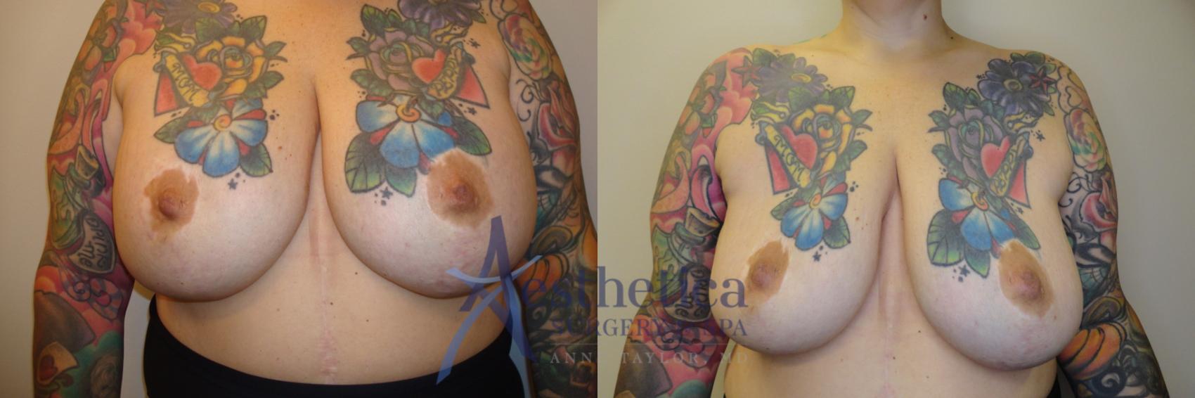 Breast Implant Removal  Case 813 Before & After Front | Columbus, OH | Aesthetica Surgery & Spa