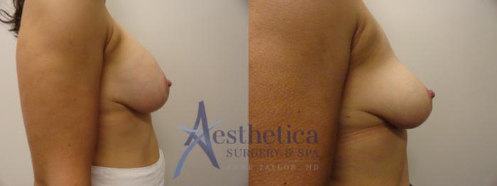 Breast Implant Removal  Case 823 Before & After Right Side | Columbus, OH | Aesthetica Surgery & Spa