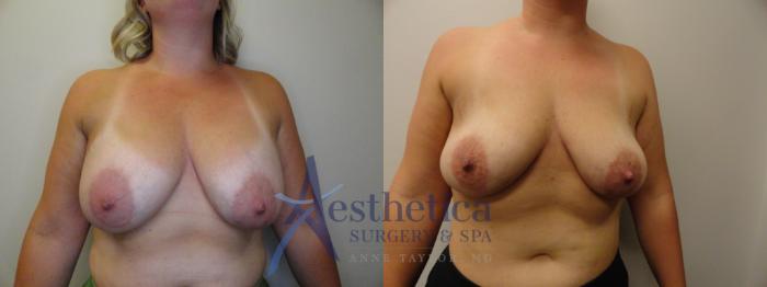 Breast Implant Removal  Case 825 Before & After Front | Columbus, OH | Aesthetica Surgery & Spa