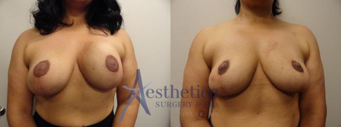 Breast Implant Removal  Case 848 Before & After Front | Columbus, OH | Aesthetica Surgery & Spa