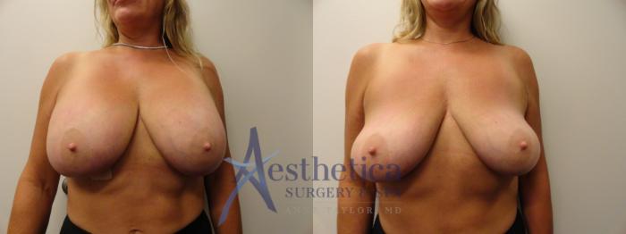 Breast Implant Removal  Case 861 Before & After Front | Columbus, OH | Aesthetica Surgery & Spa
