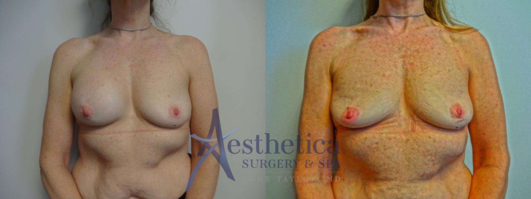 Breast Implant Removal  Case 885 Before & After Front | Columbus, OH | Aesthetica Surgery & Spa