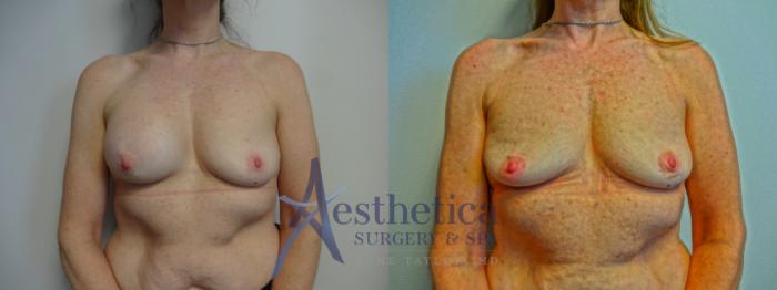 Breast Implant Removal  Case 885 Before & After Front | Columbus, OH | Aesthetica Surgery & Spa