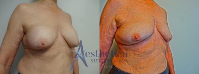 Breast Implant Removal  Case 900 Before & After Left Oblique | Columbus, OH | Aesthetica Surgery & Spa
