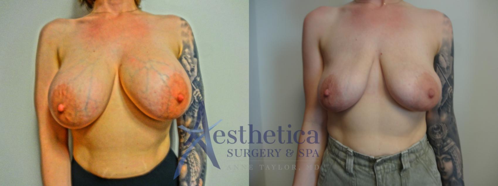 Breast Implant Removal  Case 902 Before & After Front | Columbus, OH | Aesthetica Surgery & Spa