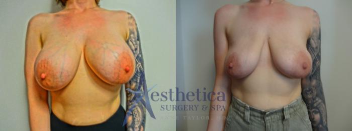 Breast Implant Removal  Case 902 Before & After Front | Columbus, OH | Aesthetica Surgery & Spa