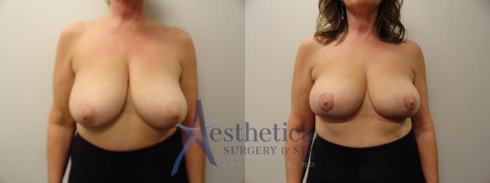 Breast Lift Case 186 Before & After View #1 | Columbus, OH | Aesthetica Surgery & Spa