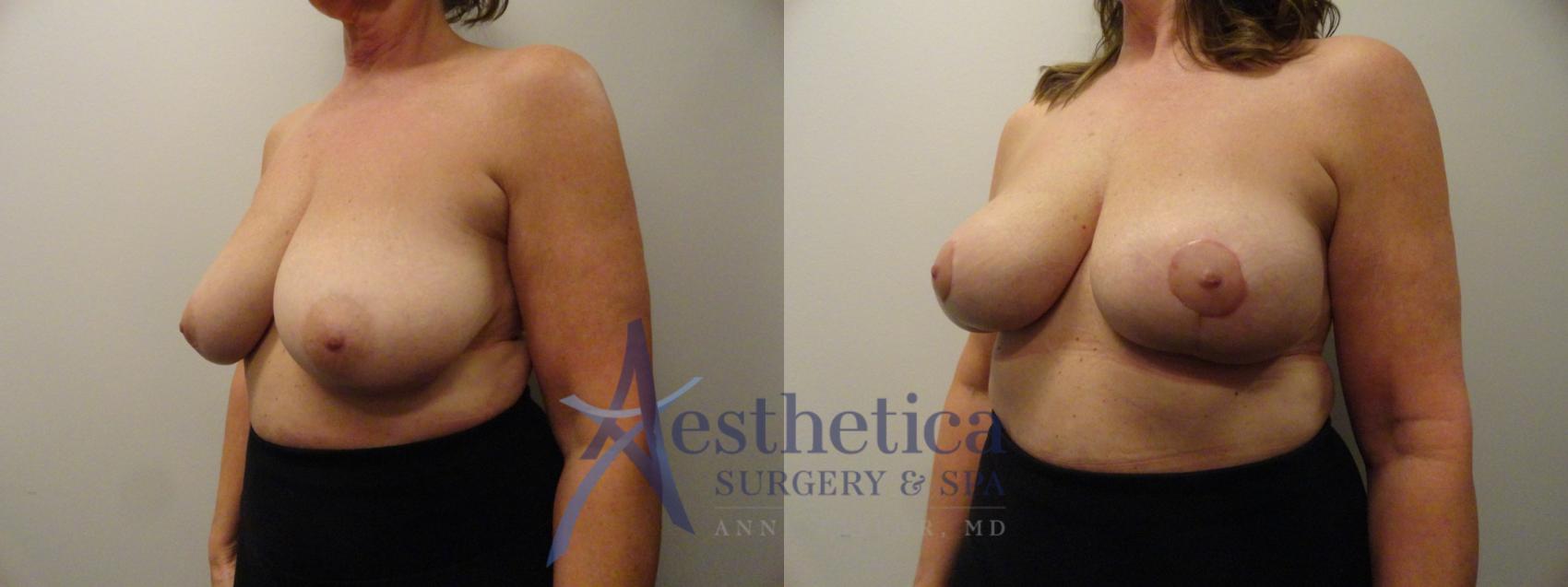 Breast Lift Case 186 Before & After View #2 | Worthington, OH | Aesthetica Surgery & Spa