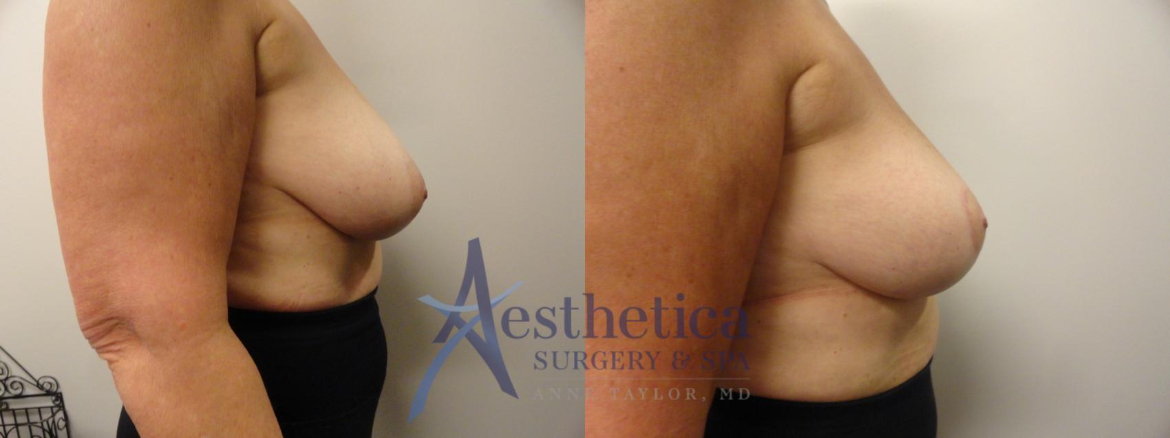 Breast Lift Case 186 Before & After View #3 | Worthington, OH | Aesthetica Surgery & Spa