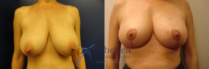 Breast Lift Case 208 Before & After View #1 | Columbus, OH | Aesthetica Surgery & Spa