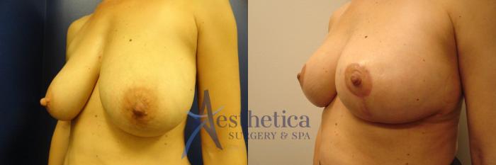 Breast Lift Case 208 Before & After View #2 | Columbus, OH | Aesthetica Surgery & Spa