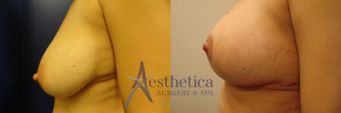 Breast Lift Case 208 Before & After View #3 | Columbus, OH | Aesthetica Surgery & Spa