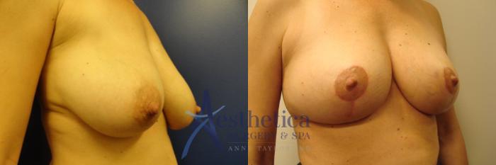 Breast Lift Case 208 Before & After View #4 | Columbus, OH | Aesthetica Surgery & Spa