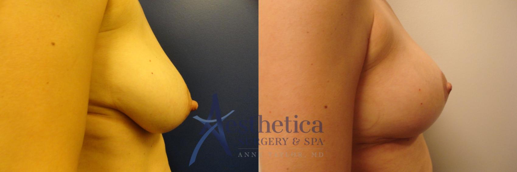 Breast Lift Case 208 Before & After View #5 | Columbus, OH | Aesthetica Surgery & Spa