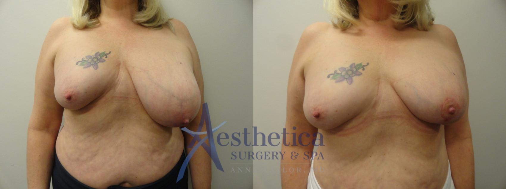 Breast Lift Case 209 Before & After View #1 | Columbus, OH | Aesthetica Surgery & Spa
