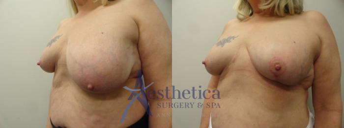 Breast Lift Case 209 Before & After View #2 | Columbus, OH | Aesthetica Surgery & Spa