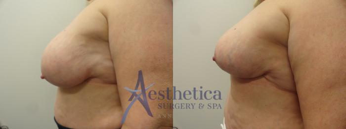 Breast Lift Case 209 Before & After View #3 | Columbus, OH | Aesthetica Surgery & Spa