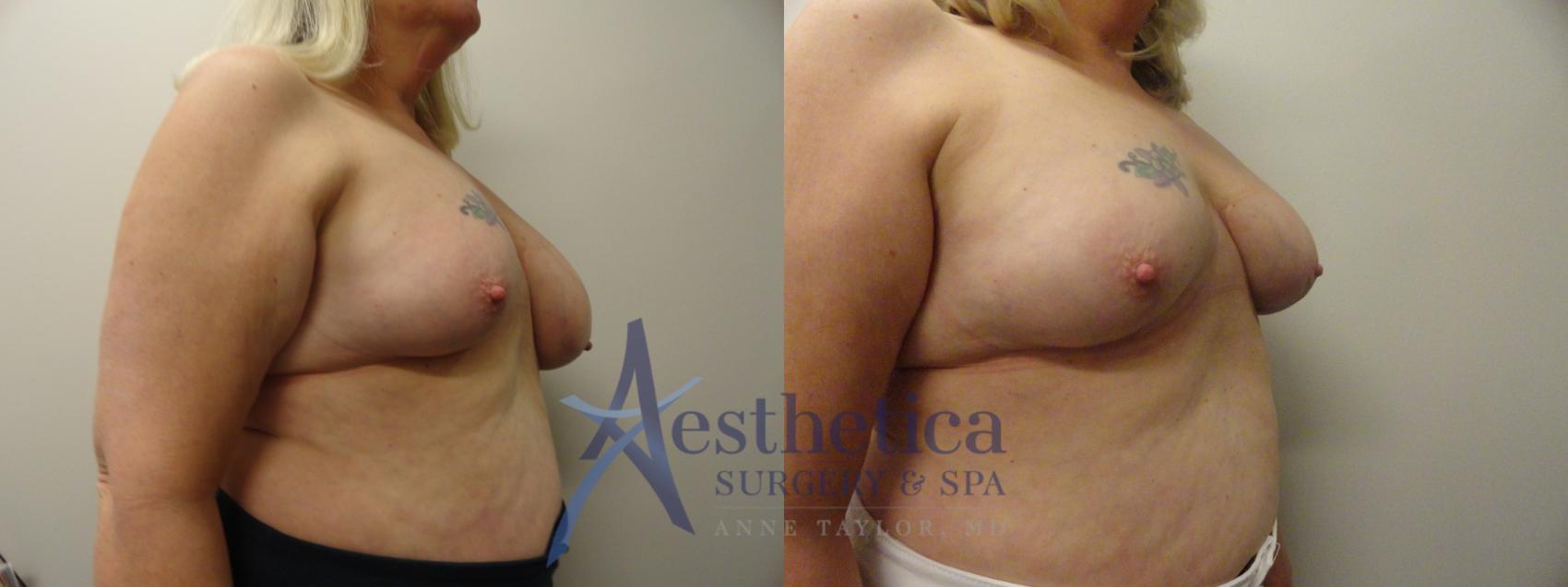 Breast Lift Case 209 Before & After View #4 | Columbus, OH | Aesthetica Surgery & Spa
