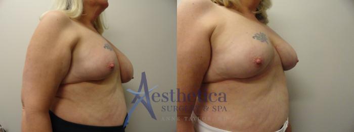 Breast Lift Case 209 Before & After View #4 | Columbus, OH | Aesthetica Surgery & Spa