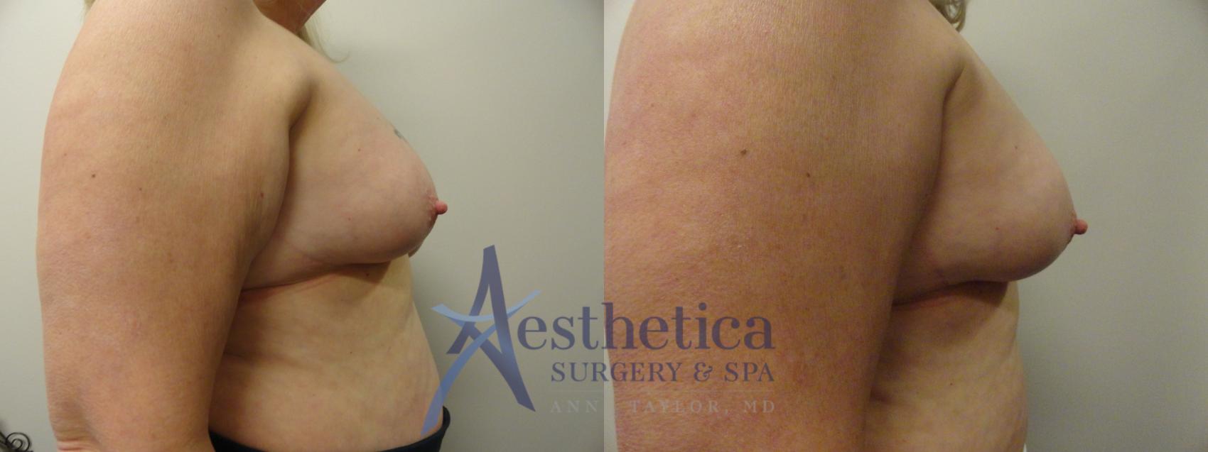 Breast Lift Case 209 Before & After View #5 | Columbus, OH | Aesthetica Surgery & Spa