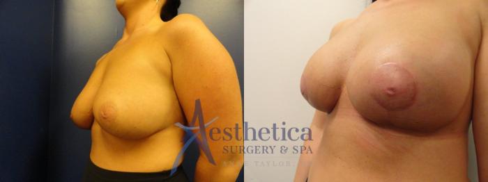 Breast Lift Case 323 Before & After View #2 | Columbus, OH | Aesthetica Surgery & Spa