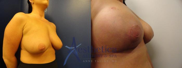 Breast Lift Case 323 Before & After View #3 | Columbus, OH | Aesthetica Surgery & Spa