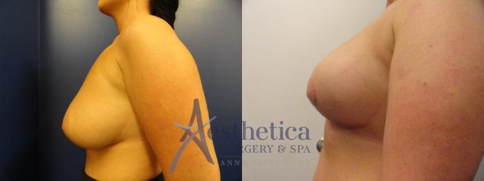 Breast Lift Case 323 Before & After View #4 | Columbus, OH | Aesthetica Surgery & Spa