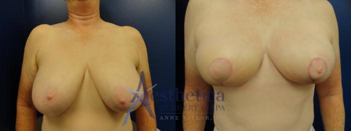 Breast Lift Case 334 Before & After View #1 | Columbus, OH | Aesthetica Surgery & Spa