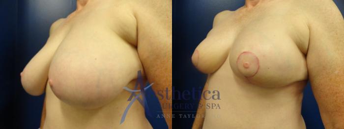 Breast Lift Case 334 Before & After View #2 | Columbus, OH | Aesthetica Surgery & Spa