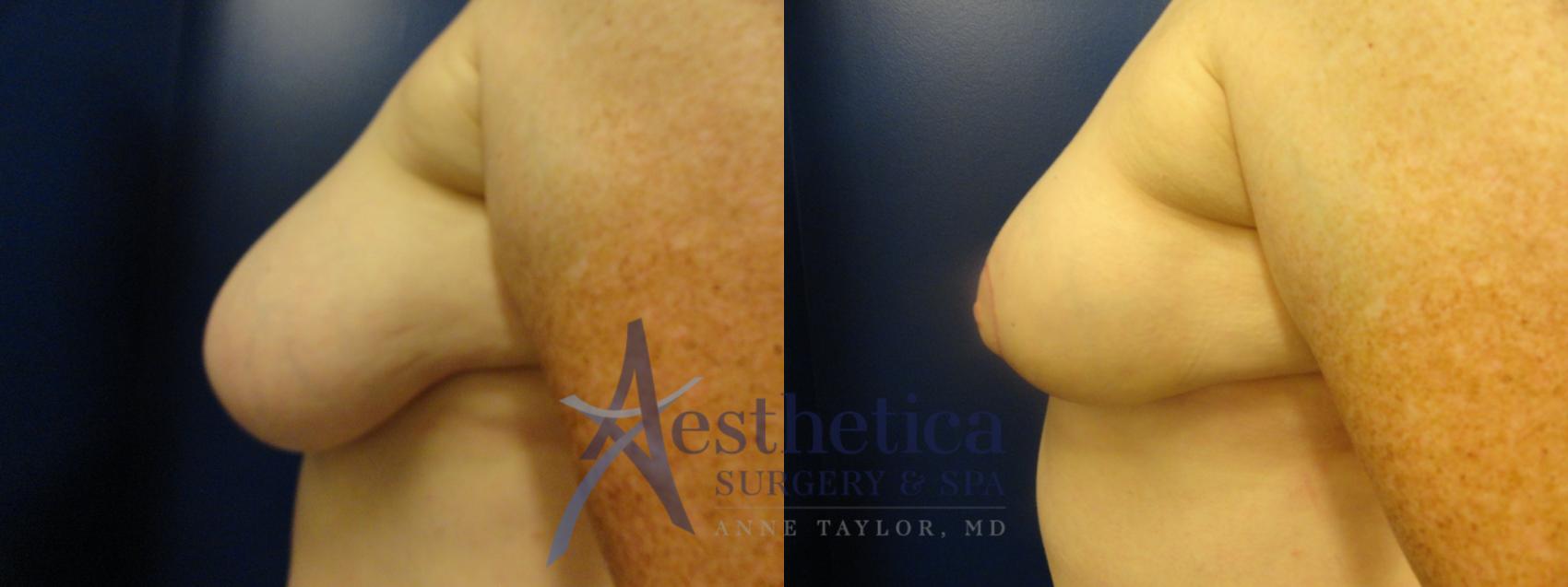 Breast Lift Case 334 Before & After View #3 | Columbus, OH | Aesthetica Surgery & Spa