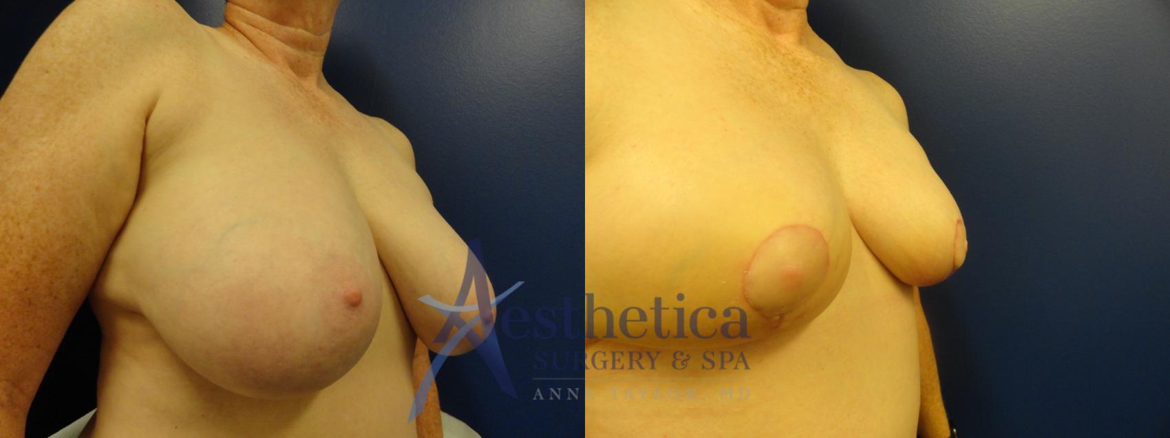 Breast Lift Case 334 Before & After View #4 | Columbus, OH | Aesthetica Surgery & Spa
