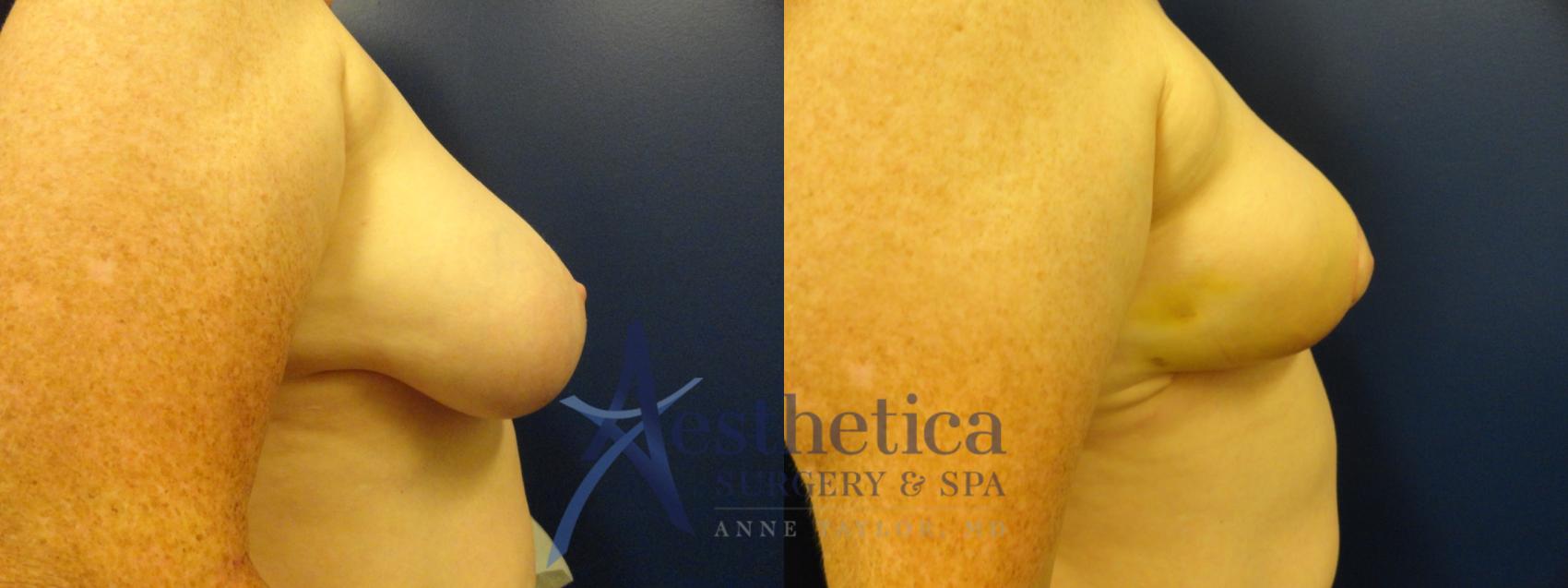 Breast Lift Case 334 Before & After View #5 | Columbus, OH | Aesthetica Surgery & Spa