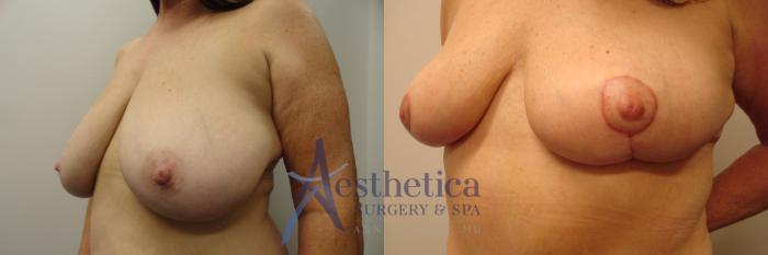 Breast Lift Case 335 Before & After View #2 | Columbus, OH | Aesthetica Surgery & Spa